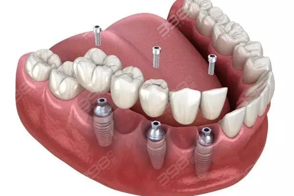 钦州市第二人民医院口腔科种植牙多少钱一颗？