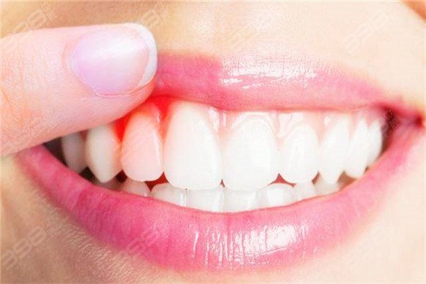 刷牙牙龈出血是怎么回事？快来看看是不是这六大原因惹的祸