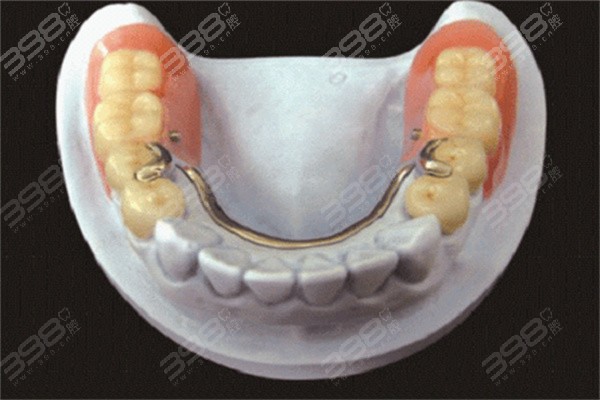 假牙vs种植牙操作方式
