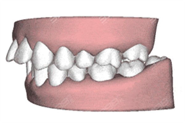各类牙齿矫正器优点