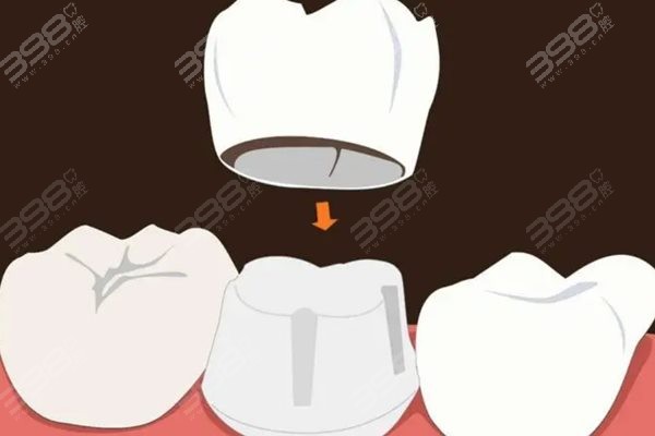 烤瓷、全瓷牙冠性价比最高的是哪种？选择哪种牙冠便宜实用？
