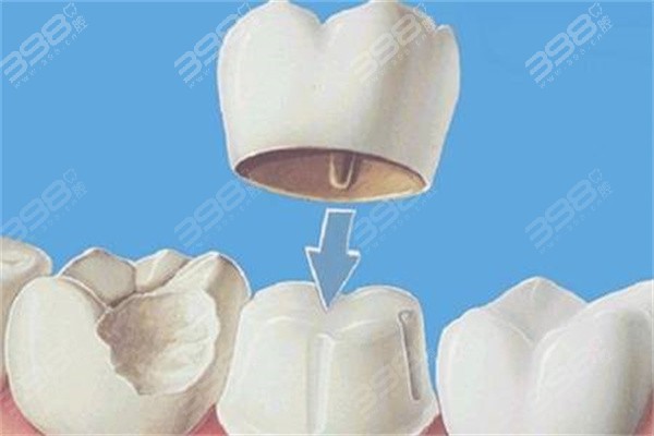 戴牙冠后里面的牙齿容易坏吗？听听牙医的专业解答及如何正确护理