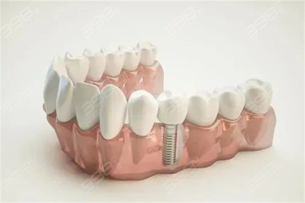 种植牙到期后有几种处理方式呢？