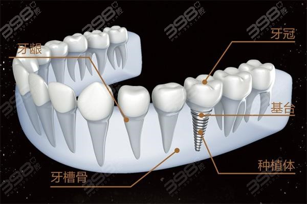 欧美/日本禁止做种植牙是真的吗？什么原因呢？