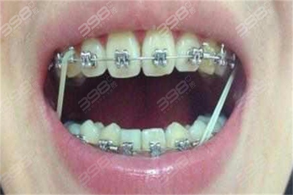 网友130****8956问：戴牙套和戴保持器哪个更难受？