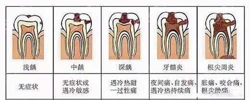龋齿一度到五度图片汇总 看看你的牙坏到什么程度