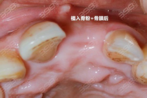 种植牙用的骨粉容易被吸收吗？
