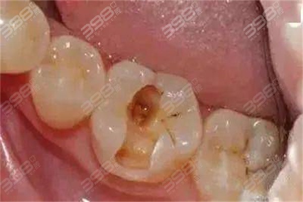 银汞合金补牙有害吗？能维持多久？和树脂补牙比哪个更好？