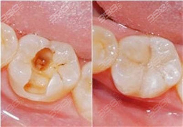乳牙龋坏应该怎么治疗