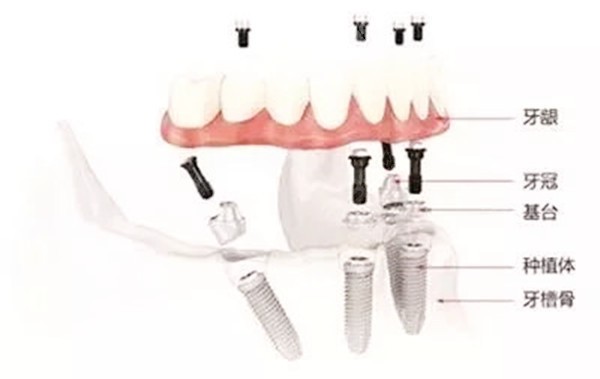 镶牙可以镶一半吗？图片详解半口镶牙的方式和优缺点