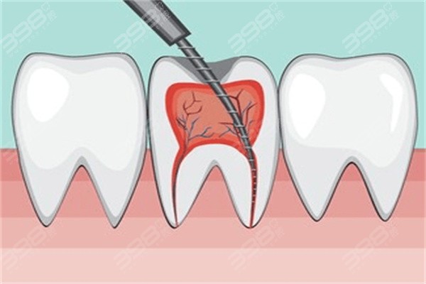 上火引起的牙疼和龋齿牙疼有什么区别？