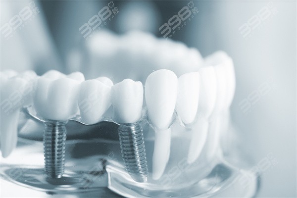 数字化种植牙和传统种植牙哪个好？深扒两种修复方式的区别