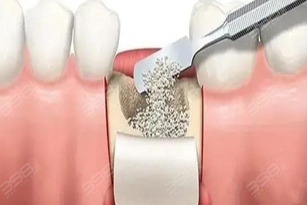 牙槽骨高度和宽度满足多少可以种植牙