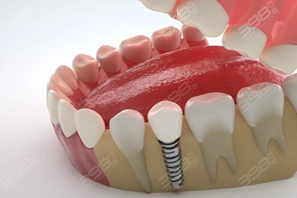 活动义齿和种植牙的区别是什么？