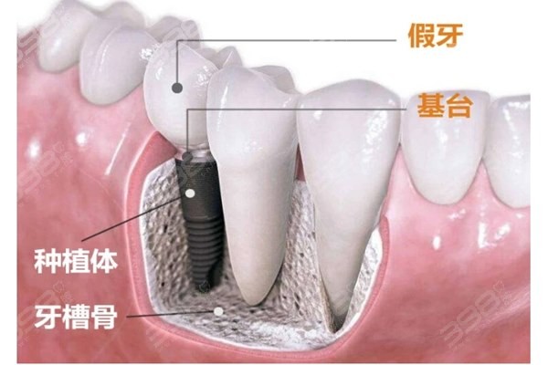 牙槽骨种植牙条件