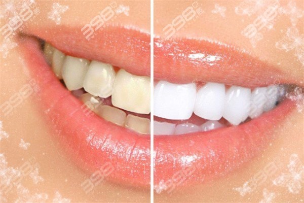 用久了的牙贴面会对口腔产生什么影响吗？