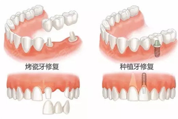 全口假牙有几种种类？来看全口假牙不同种类材质、价格等区分
