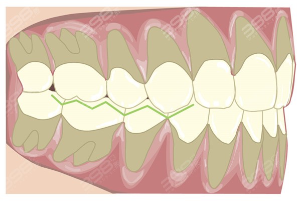 牙齿咬合重建技术很难吗？和正畸的区别非常大对医生技术要求高