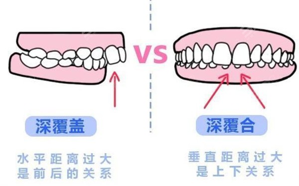 牙齿咬合重建和正畸的区别是什么