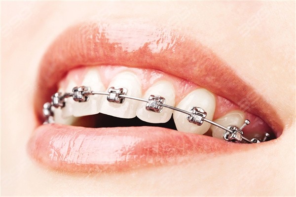金属牙套是怎么固定在牙齿上的