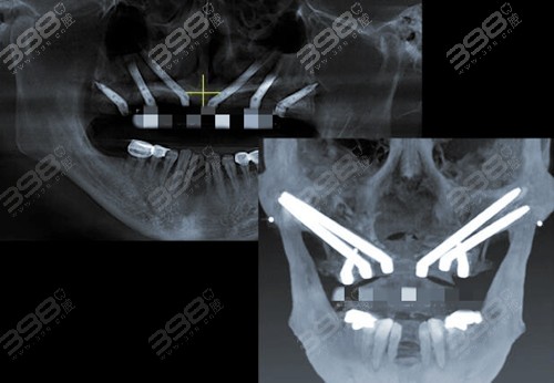 重度牙龈萎缩是可以进行种植牙修复，但是不建议