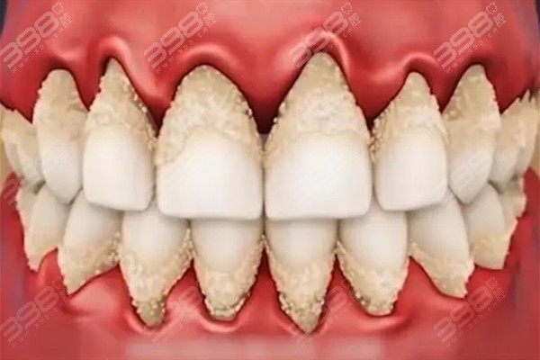 满口牙龈萎缩还可以做种植牙吗？