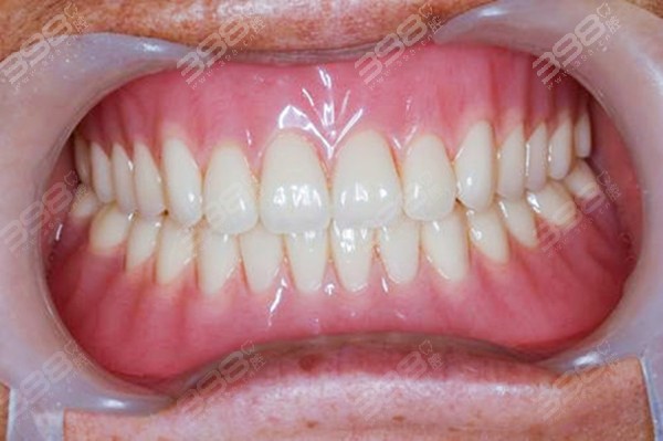 满口牙龈萎缩能安假牙吗