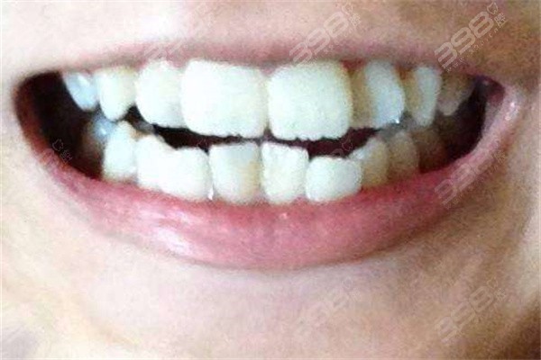 骨性龅牙和牙性龅牙怎么区分？
