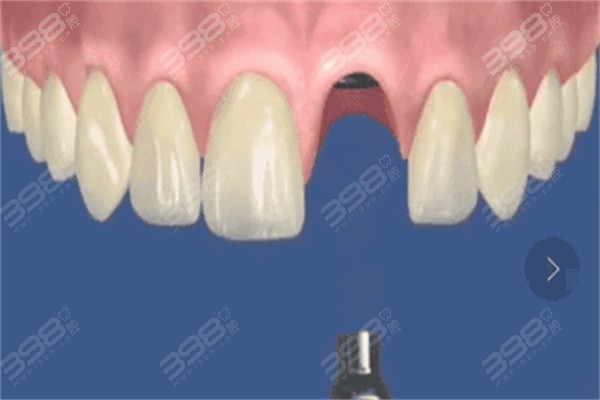 一段式种植牙和二段式种植牙有什么区别？