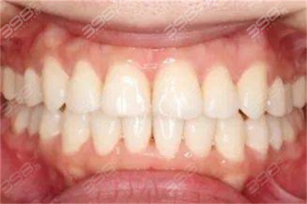 骨性龅牙和牙性龅牙都该怎么治疗？