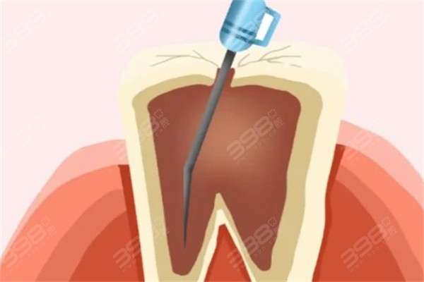 牙神经坏死后牙齿可以用几年？