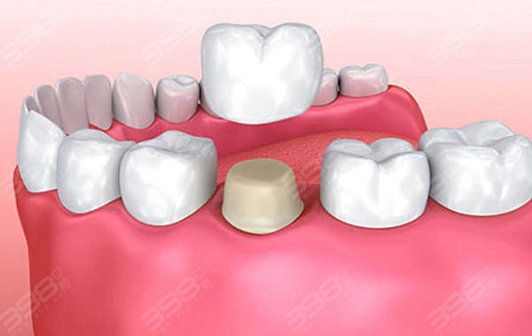 牙套与牙冠的区别是啥？是同一种东西吗？