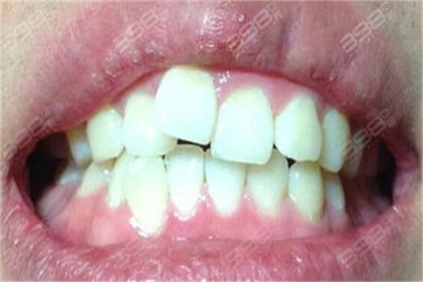 牙套脸应该怎么避免？