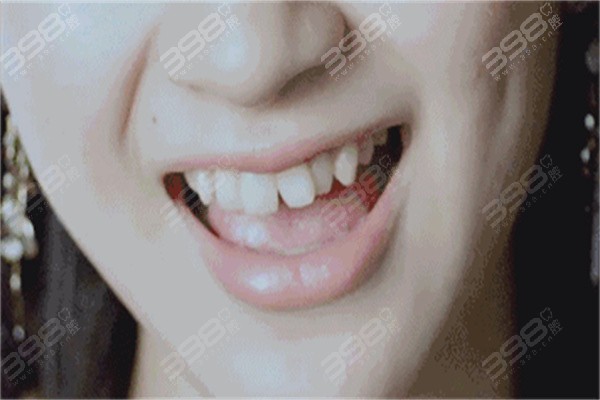 牙套脸怎么恢 复原来的脸型？