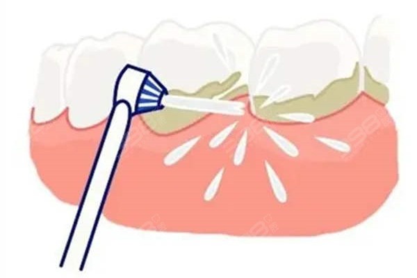 承德口腔医院补牙、拔智齿、根管治疗、牙齿美白、儿牙治疗收费标准