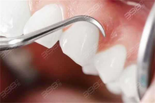 龈下刮治后更容易长牙结石吗？多久能恢复正常？日常清洁很重要