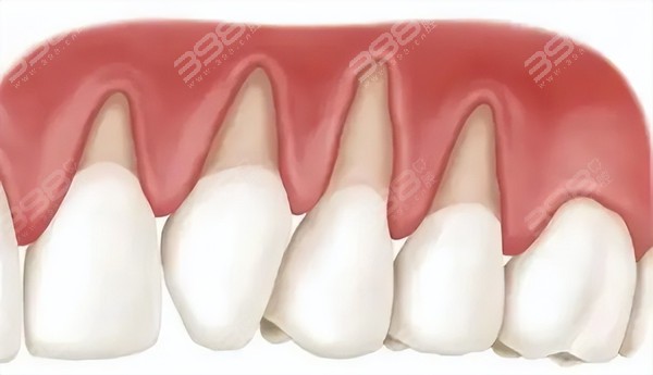 种植牙术后引发牙周炎的风险
