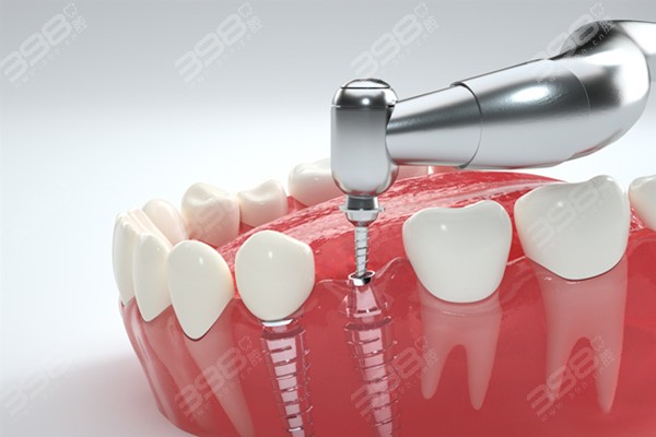 种植牙术后会引发牙槽骨萎缩的情况