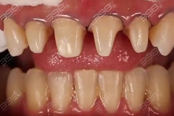 牙齿磨小戴牙套后遗症有哪些？