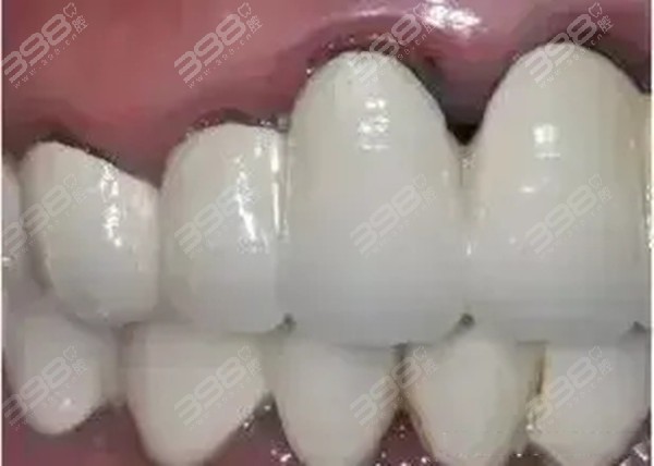缩短磨小牙齿的使用寿命，伤害邻牙的使用寿命