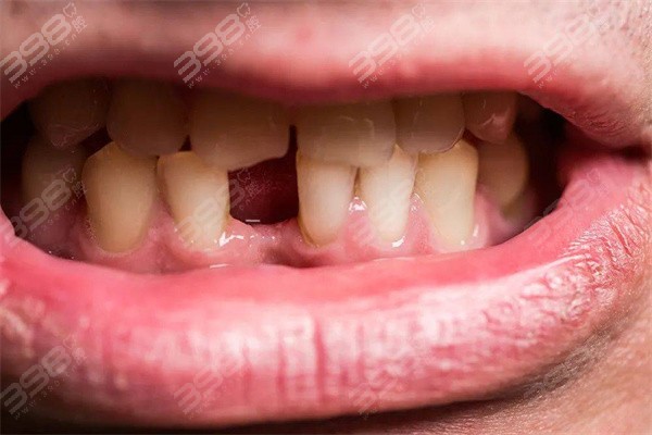 大牙拔掉后不补会有什么影响？位移或脱落，及时修复很重要